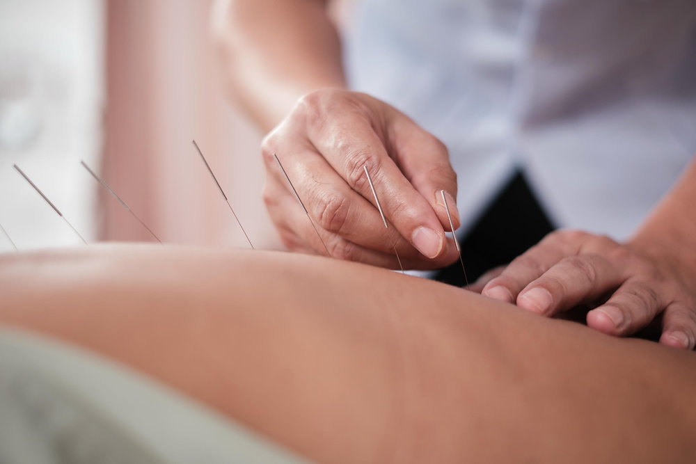 Acupuncture treatment session at Elements PT Lethbridge